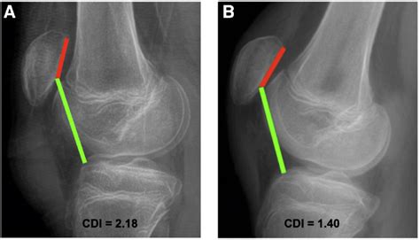 Perfect Lateral Radiographs Of The Right Knee A Preoperative