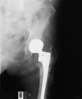 22 OT TOTAL HIP ideas | hip replacement, total hip ...