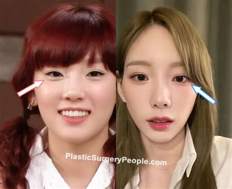 Taeyeon Before And After