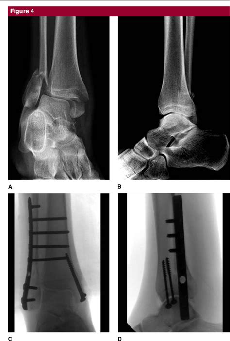 Figure 4 From Complications Of Ankle Fracture In Patients With Diabetes