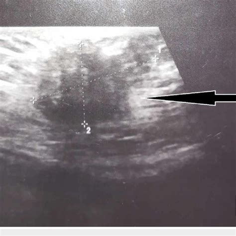 Ultrasound Of The Abdomen Showing A Hypoechoic Mass Endometrioma