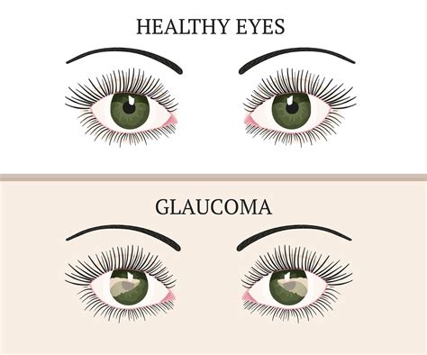 By john berdahl, md glaucoma is often called the silent thief of sight, because most o. Glaucoma Information for Your Elderly Loved One