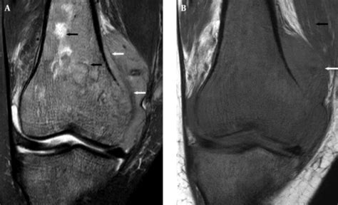 A Coronal T2 Weighted Fat Suppressed Mri Of The Knee Open I