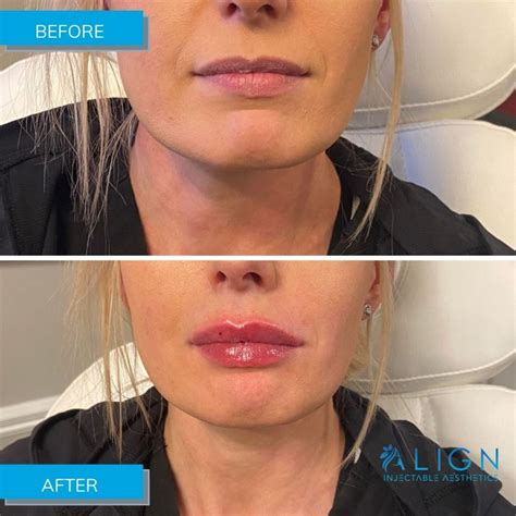 Before And After Lip Filler At Align Injectable Aesthetics