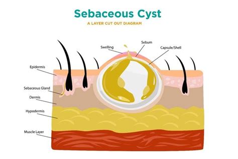 Symptoms And Treatments Of Sebaceous Cysts Facty Health