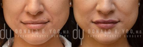 Before And After Treating Nasolabial Fold Smile Lines With Juvederm