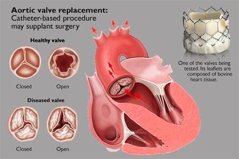Aortic Valve Replacement 7 Orange Hospital Cardiology And Heart