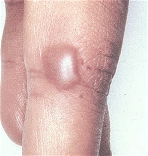 Slapped some of it on and went to practice the next day. Case Rounds : Case 5 - Arthritis Information