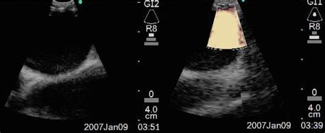 Endobronchial Ultrasound Guided Transbronchial Needle Aspiration Ebus