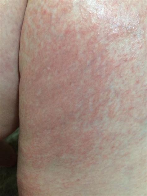 Painful Rash On Inner Thighs When Coldhot Rskin