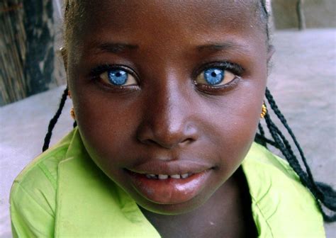 In pakistan, having blonde hair and blue eyes isn't that uncommon, as seen in the kalash peoples. Stunning blue eyes. A girl with Waardenburg Syndrome ...