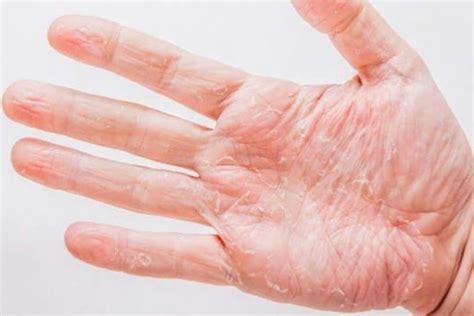 7 Home Remedies For Dry Cracked Hands Skin Care Geeks