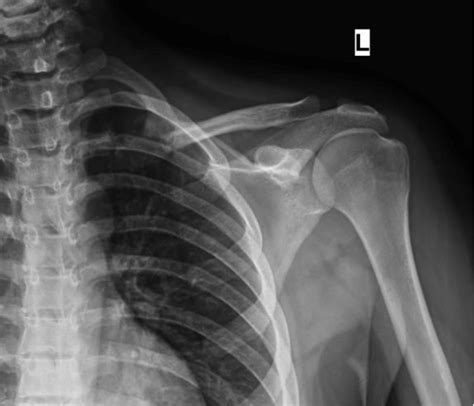 Figure 2 From Aneurysmal Bone Cyst Of Medial End Of Clavicle A Rare