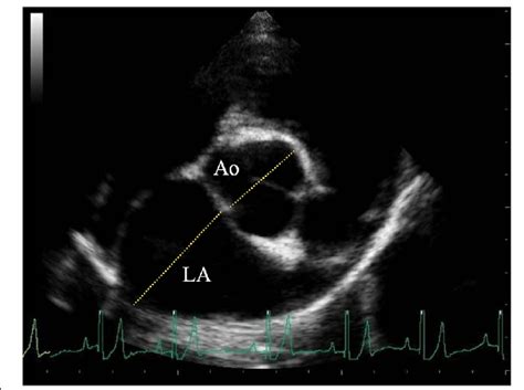 2d Right Parasternal Short Axis View At The Aortic Root Level The