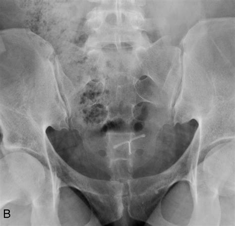 Figure 1 From Postpartum Sacral Fracture In A 30 Year Old Female