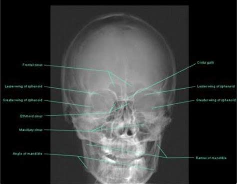 Normal Radiographic Anatomical Landmark Of Maxilla And Mandible