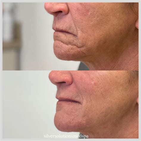 Hydrafacial Before And After Gallery Silver Solutions Medspa