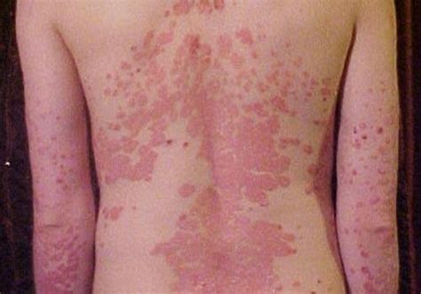 Dermatology Pictures Of Common Skin Rashes Medhelp