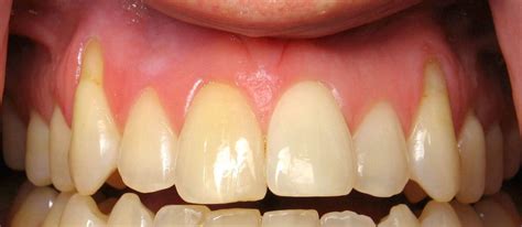 Receding Gums Causes Treatment Surgery And Prevention Vancouver