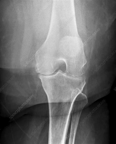 Osteoarthritis Of The Knee X Ray Stock Image C0299869 Science