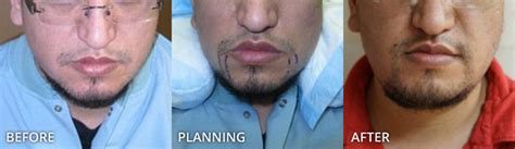 Looking for hair transplant in india at low cost, get the facial hair transplant like eyelid, eyelash, beard, moustache and hair fall follicare hair solution offers the best hair implant surgery in your city. Facial Hair Transplantation Chicago* | Dr Turowski ...