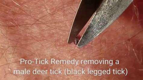 Pro Tick Remedy Removing Deer Tick Male Youtube