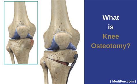 Knee Osteotomy Surgery And Recovery