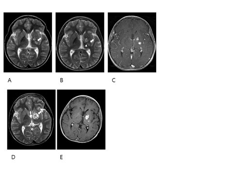 Mr Imaging Findings Of Germ Cell Tumors Arising From The Basal Ganglia