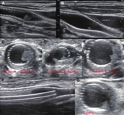 Carotid Duplex View A And B The Two Mobile Plaques Are Detected In