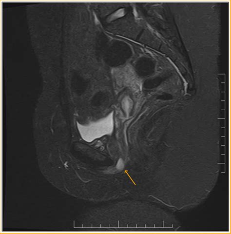 Urethral Diverticulum Mri Sumer S Radiology Blog
