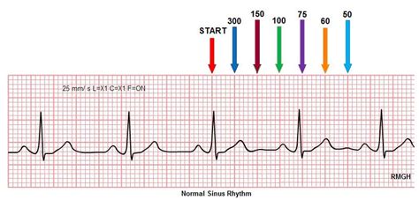 Learning How To Read Electrocardiograms Ekgs Can We Calculate The Rate