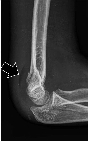 Undisplaced Fracture Of The Distal Humerus Shows The Fat Pad Sign