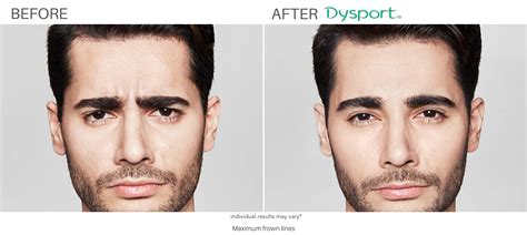 Botox And Dysport Smooth Wrinkles And Fine Lines Neurotoxin Injectables