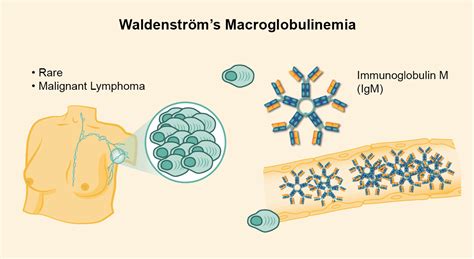 Symptoms Waldenströms Macroglobulinemia
