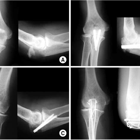 A Radiographs Show Olecranon Fracture Of Type Iia B These