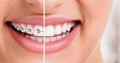 Advantages Of Invisalign Vs Traditional Braces Absolute Dental Care