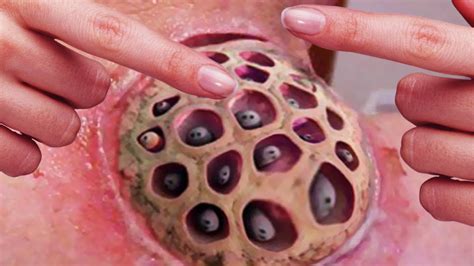 What Is Trypophobia What Causes Fear Of Holes Viral On