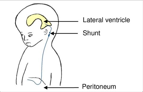 Position Of Ventriculo Peritoneal Shunt Download Scientific Diagram