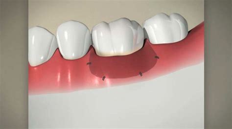 Gingival Grafting Forest And Ray Dentists Orthodontists Implant