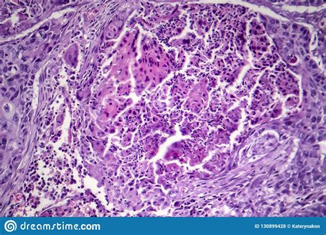 Squamous Cell Carcinoma Of The Lung Stock Photo Image Of Pathology
