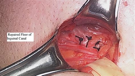 Post Op Instructions For Inguinal Hernia Repair Form Viha