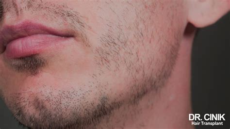 Patchy Beard Causes And Solutions For A Denser Beard