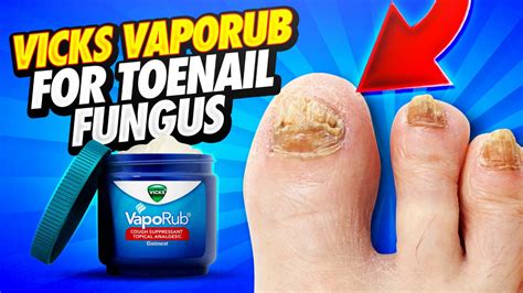 Why You SHOULD NOT Use Vicks Vaporub For Toenail Fungus Here S What I Ve Learned YouTube