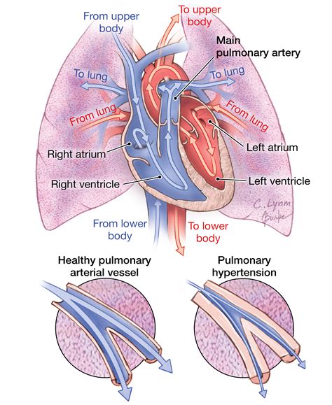 Pulmonary Hypertension Cardiology Jama Jama Network
