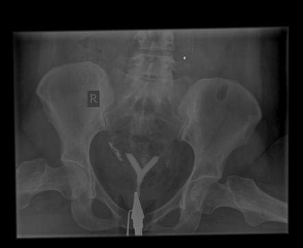 Septate Uterus Radiology Case Radiopaedia Org