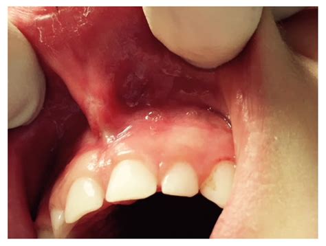 Ijerph Free Full Text Laser Surgical Approach Of Upper Labial Frenulum A Systematic Review