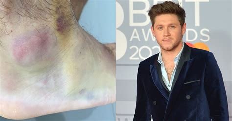 Niall Horan Shows Off Foot Injury After Mishap While Six Pints Deep
