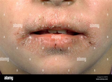Lip Licking Eczema Stock Photo Alamy