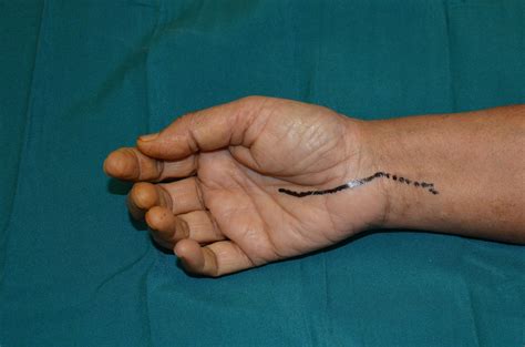 Carpal Tunnel Syndrome Surgical Release Carpal Tunnel Syndrome