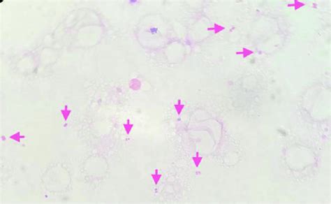 Gram Stain Of Blood Cultures Demonstrating Gram Negative Diplococci In